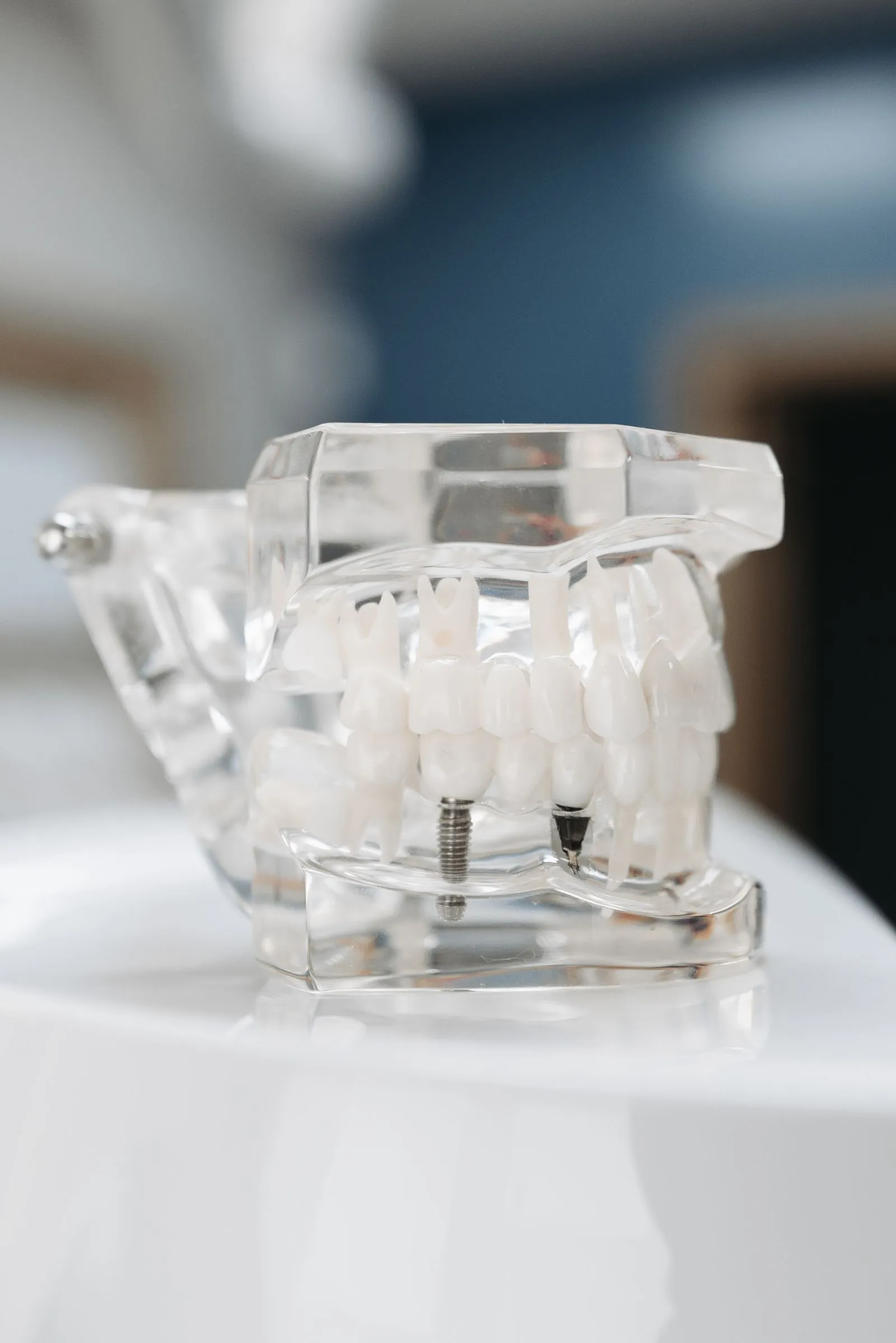 Modelo dental que muestra un implante de titanio junto a las piezas naturales en la Clínica Dental Lara Mosquera