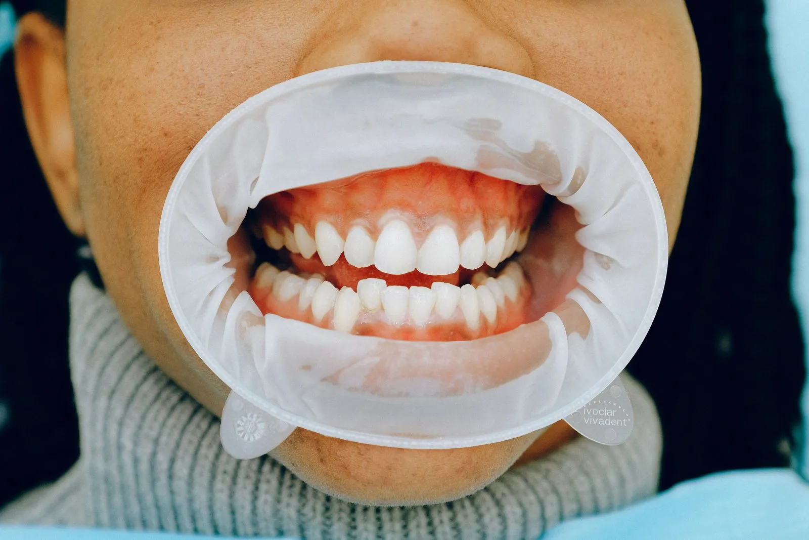 Primer plano de una boca con retractor durante una revisión de encías en la Clínica Dental Lara Mosquera